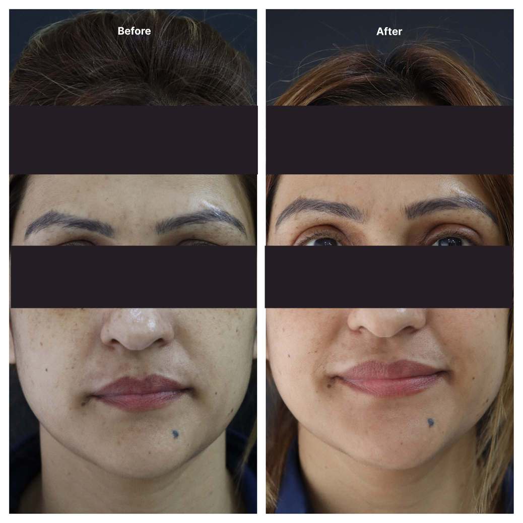 Eyelid Surgery KOQ10